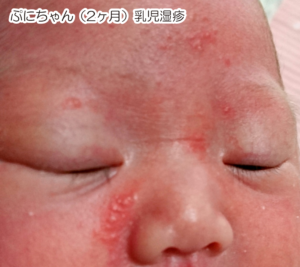 乳児湿疹 わが家の治った方法 乳児湿疹の画像 写真 で紹介 ひまぷら